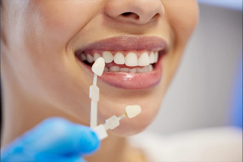 Imagem sobre clareamento: Clareamento dental em Joinville: opções, cuidados e limitações