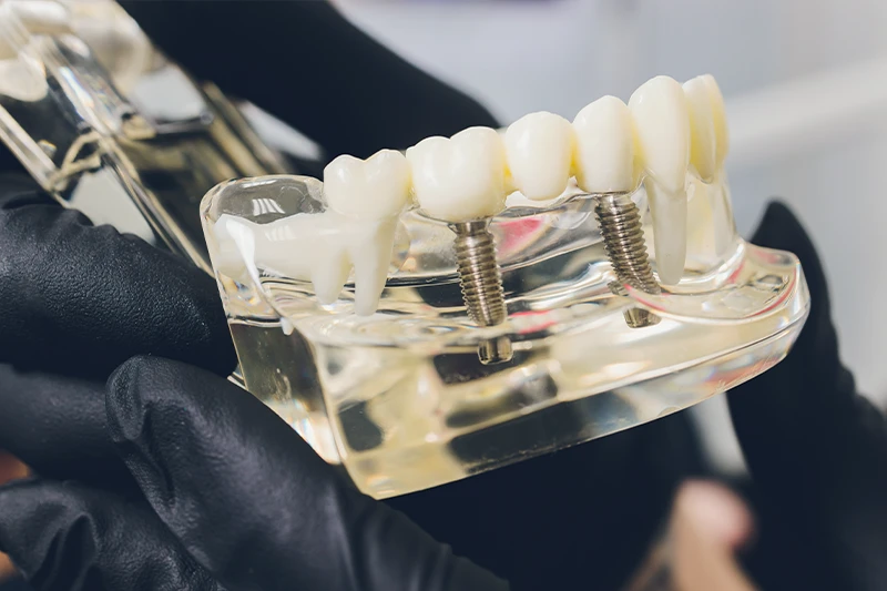 Pós-operatório de implante dentário: cuidados e sinais de alerta - imagem complementar