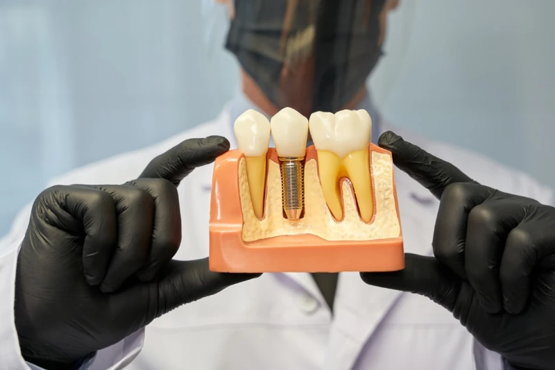Imagem sobre implantes: Como o implante se integra ao osso? Entenda a osseointegração