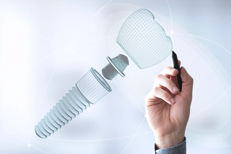 Imagem sobre implantes: Implantes dentários: 7 mitos e verdades explicados