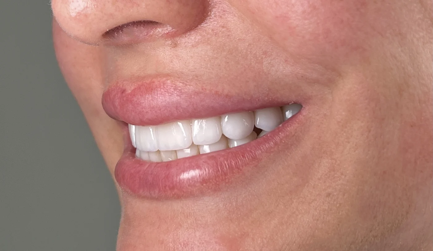 Imagem sobre facetas: Facetas: o que avaliar antes de decidir?