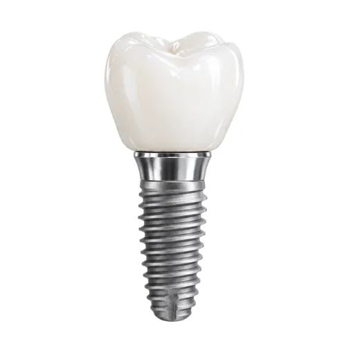 Modelo ilustrativo de um implante dentário