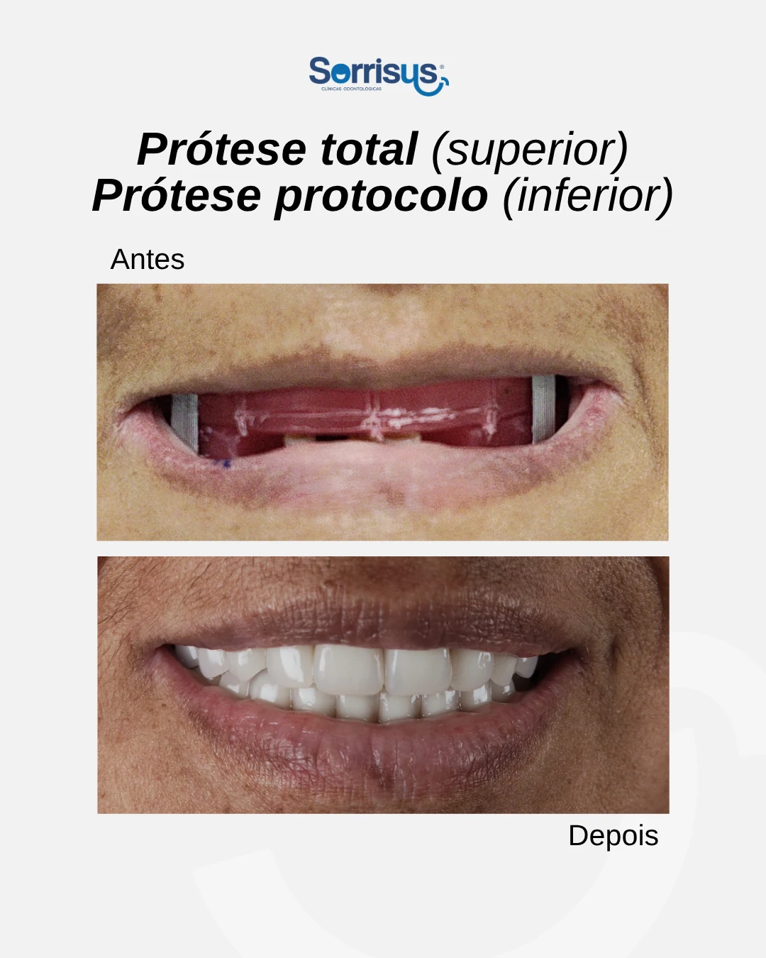Registro de antes e depois de tratamento na Sorrisus — caso 1