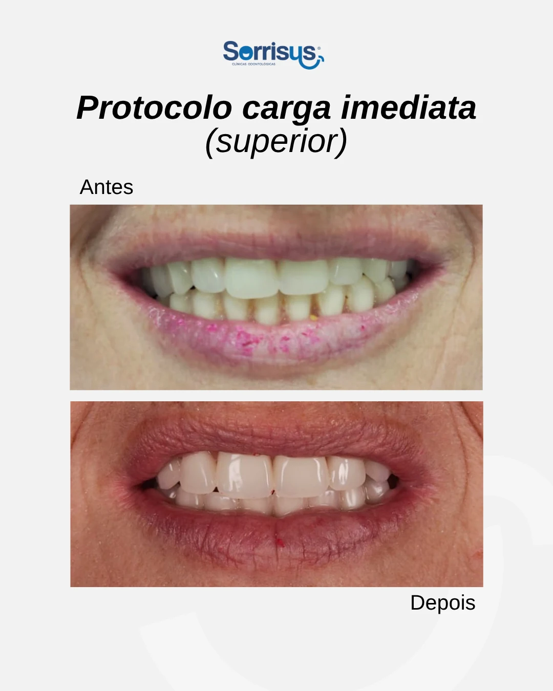 Registro de antes e depois de tratamento na Sorrisus — caso 10