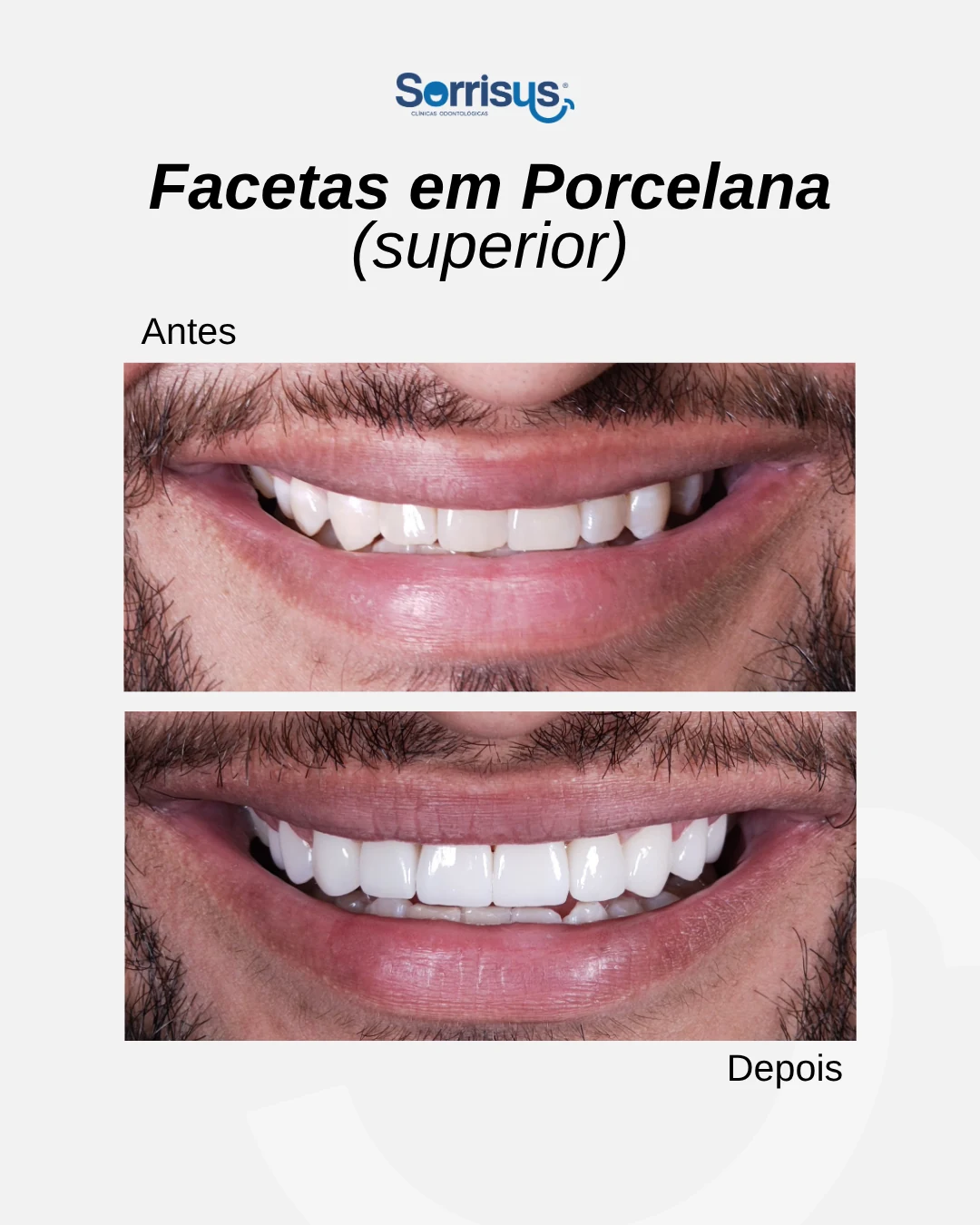 Registro de antes e depois de tratamento na Sorrisus — caso 11