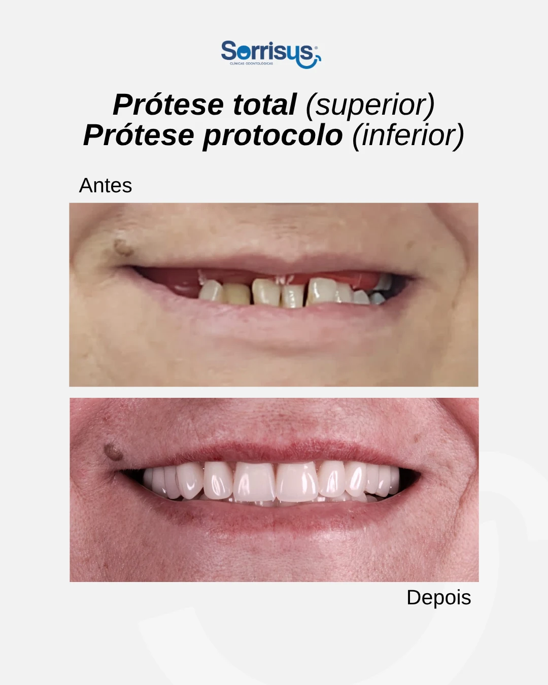 Registro de antes e depois de tratamento na Sorrisus — caso 12
