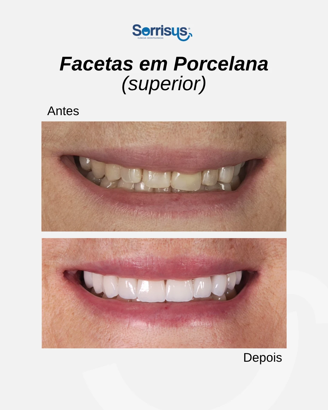 Registro de antes e depois de tratamento na Sorrisus — caso 13