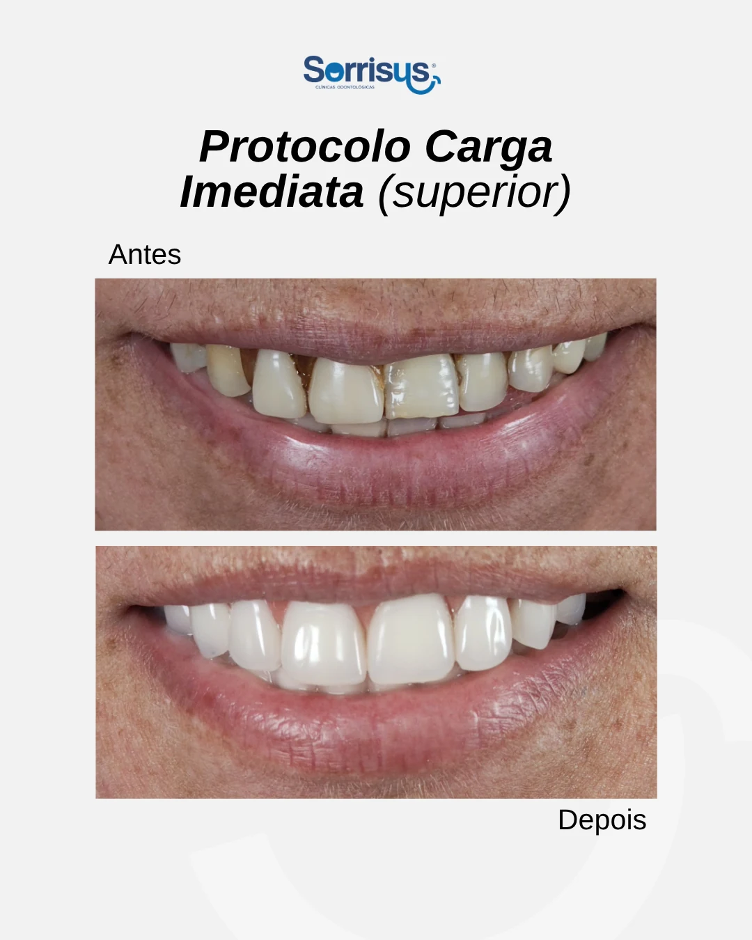 Registro de antes e depois de tratamento na Sorrisus — caso 2