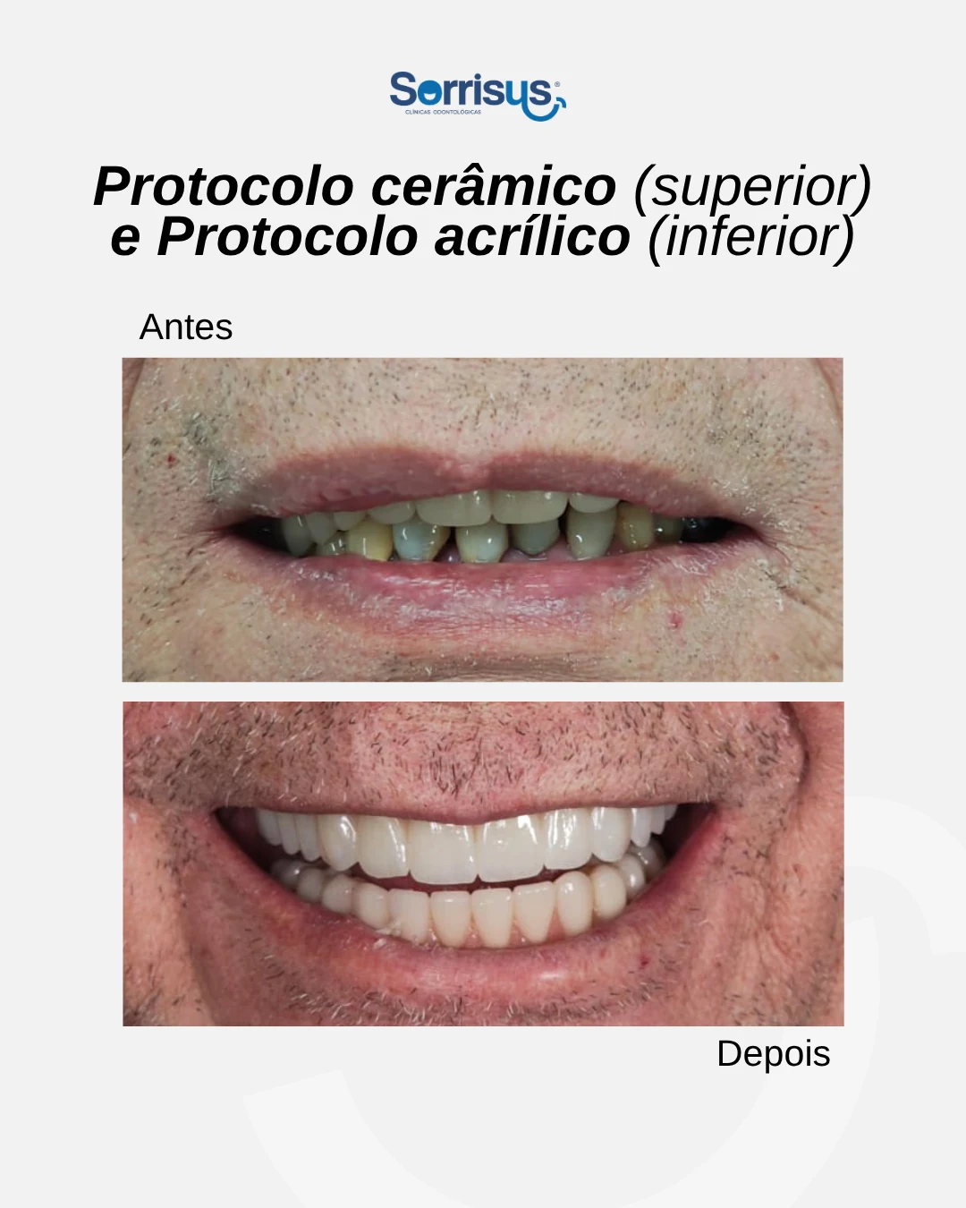 Registro de antes e depois de tratamento na Sorrisus — caso 3