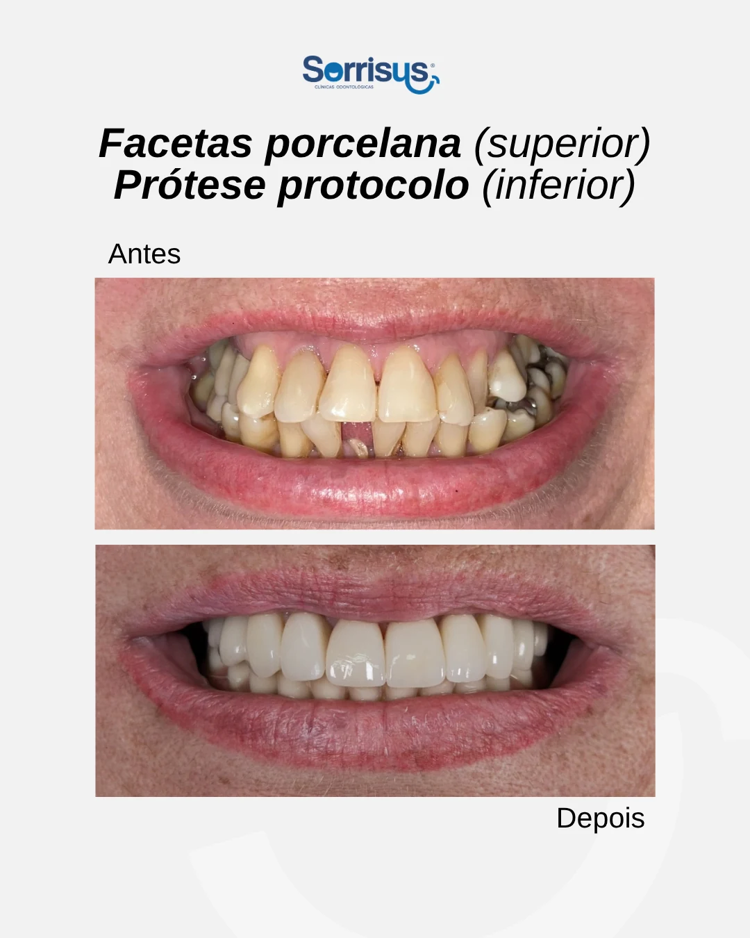 Registro de antes e depois de tratamento na Sorrisus — caso 4