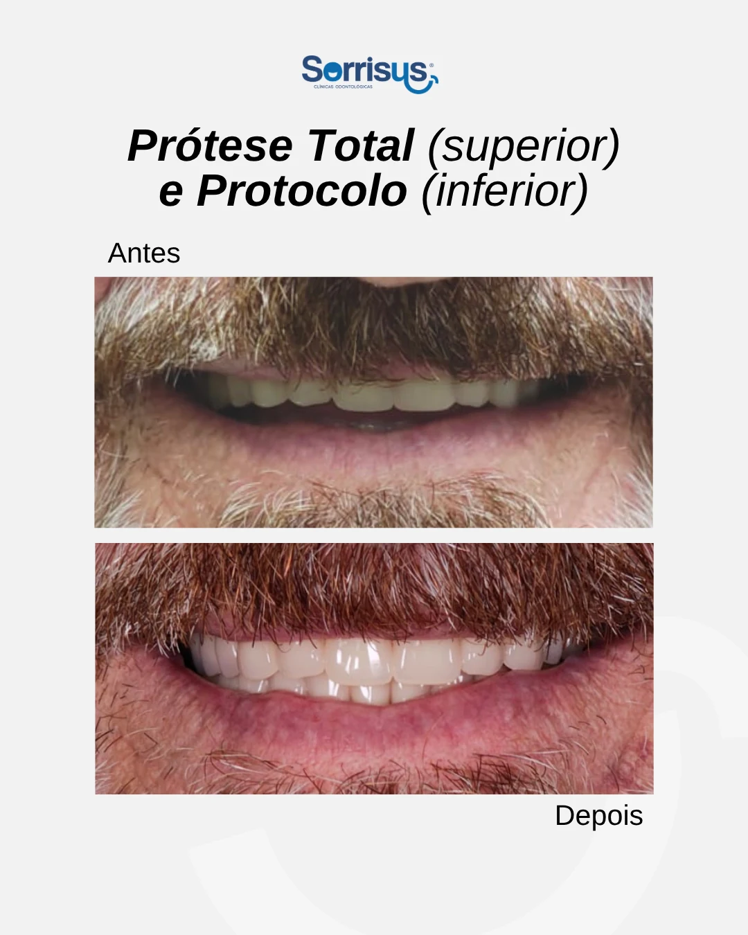 Registro de antes e depois de tratamento na Sorrisus — caso 5
