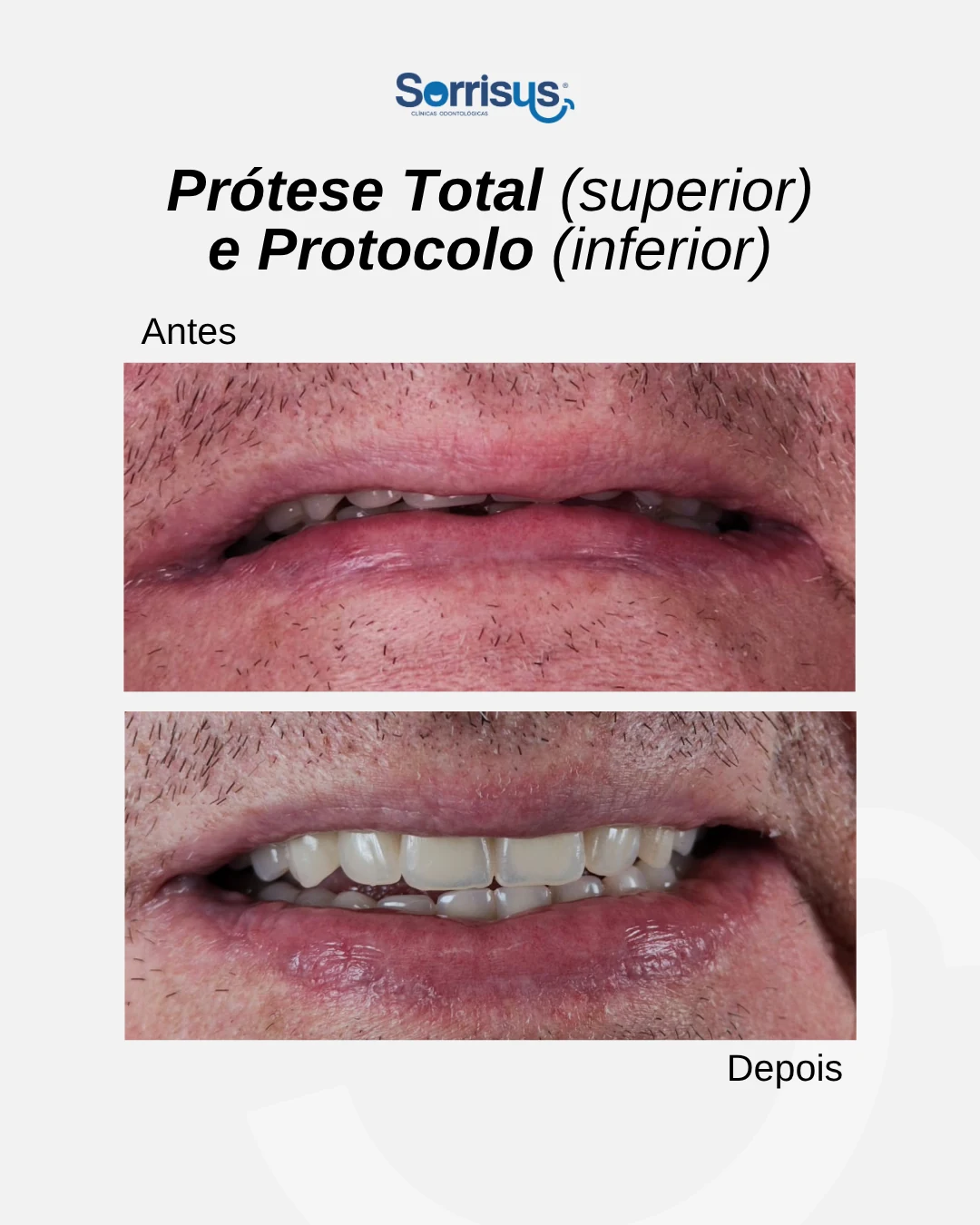 Registro de antes e depois de tratamento na Sorrisus — caso 6