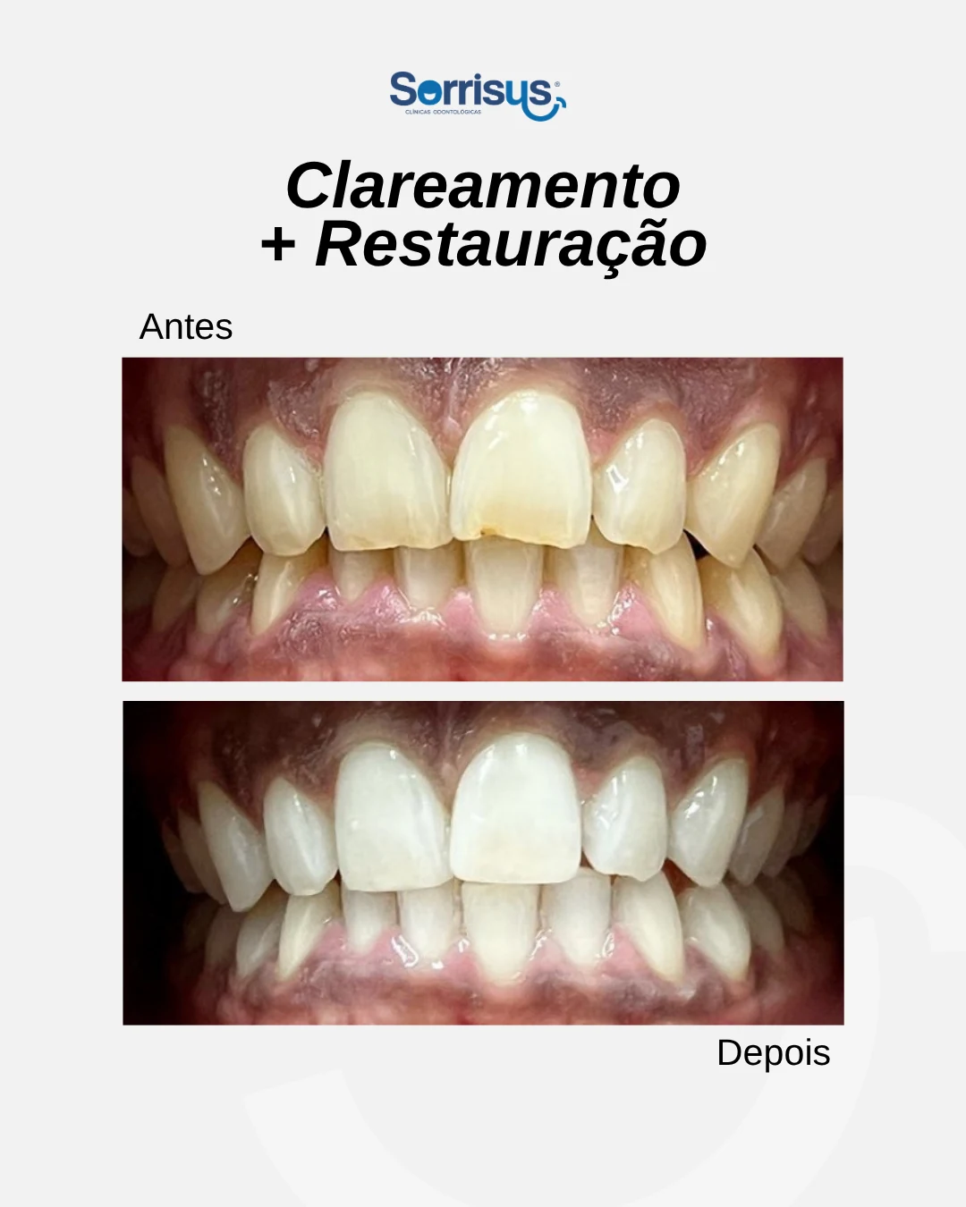 Registro de antes e depois de tratamento na Sorrisus — caso 7