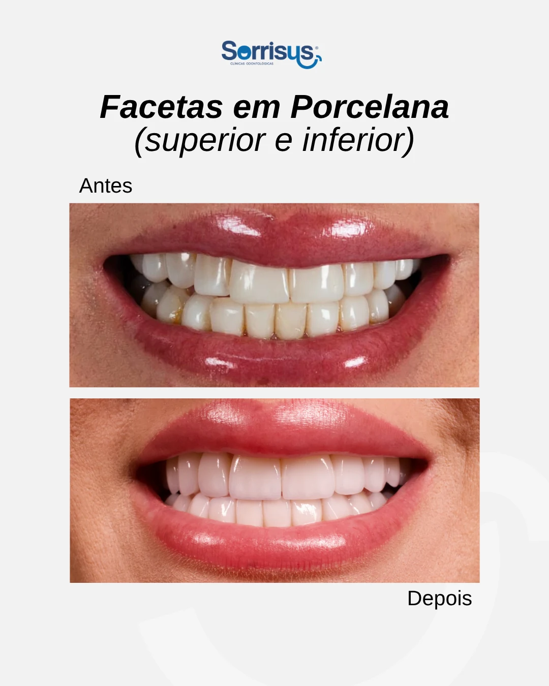 Registro de antes e depois de tratamento na Sorrisus — caso 8