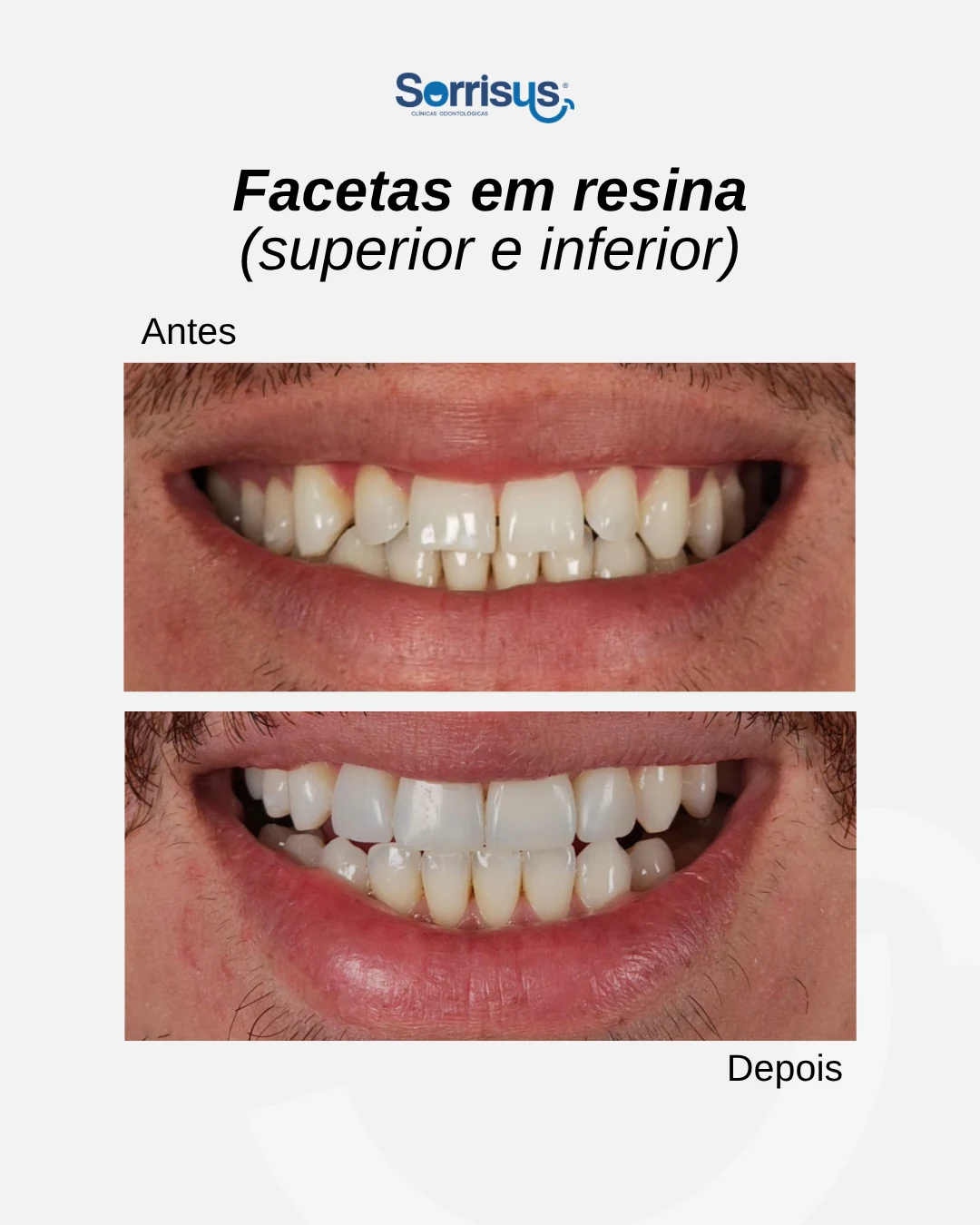 Registro de antes e depois de tratamento na Sorrisus — caso 9